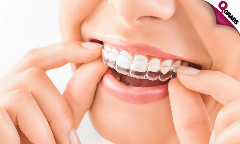 Teeth Whitening, Direct Composite Veneers & More!